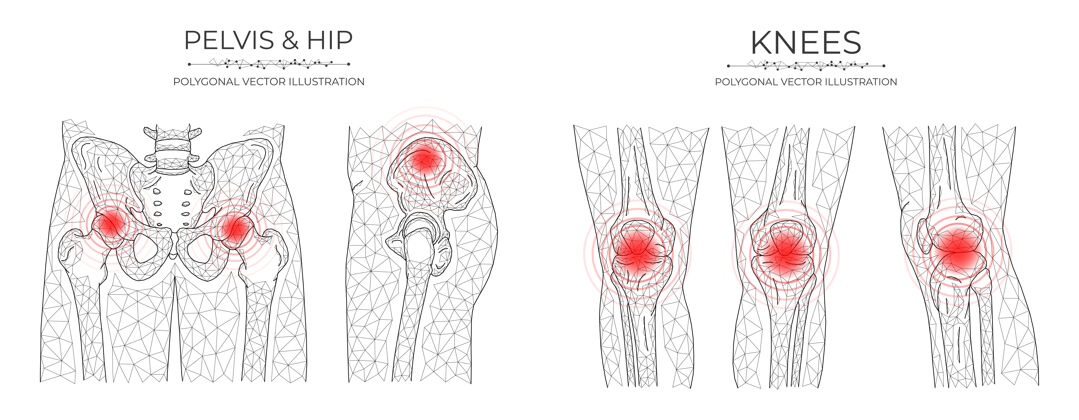 医学骨盆和膝盖的多边形矢量图疼痛医疗骨科疾病模板关节点骨科