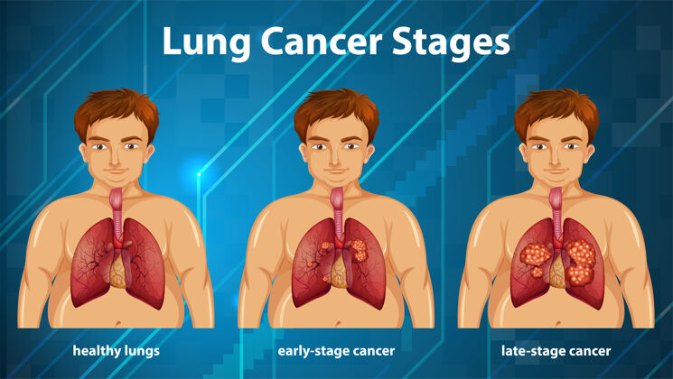 癌症肺癌分期的资料性说明细节健康学习